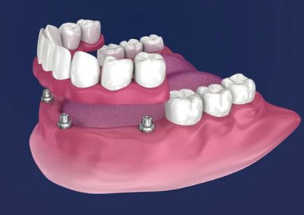 How much are all on four dental implants in Turkey, Antalya?