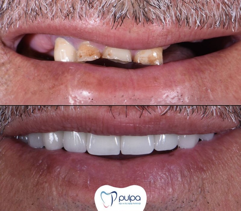 All on 4 dentures advantages in turkey