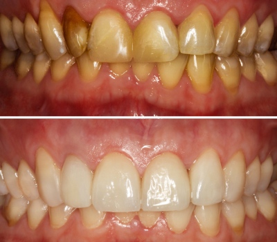 How to deal with antibiotic / tetracycline-stained teeth? in Turkey Antalya
                  Alanya Dental Clinic