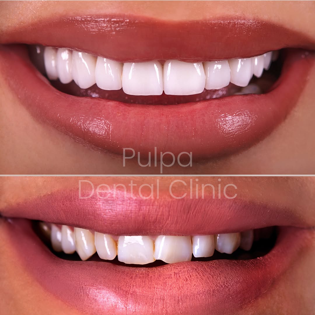 zirconium veneers in alanya